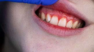 lo-scorbuto-e-la-vitamina-c-la-storia-di-una-malattia-terribile