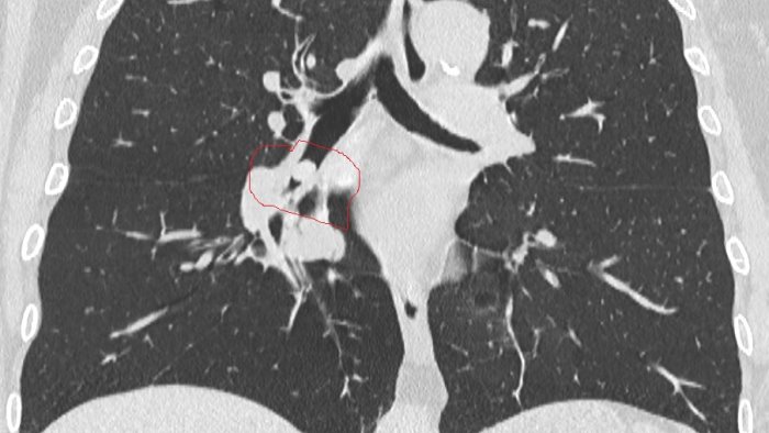 settantenne inala un seme di cecio salvata in ospedale a eboli