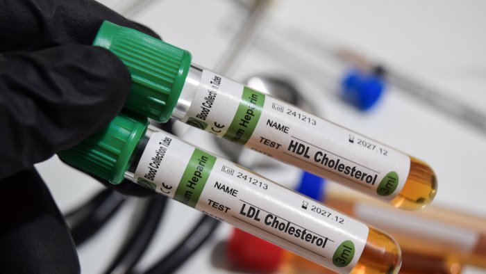 colesterolo e rischio cardiovascolare ecco i consigli dell esperto