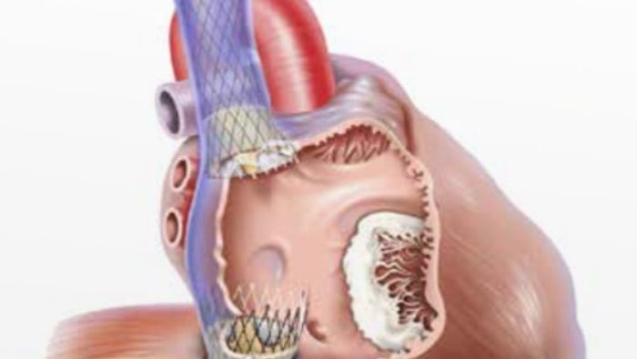 impianto percutaneo valvola tricuspide primo a benevento al fatebenefratelli