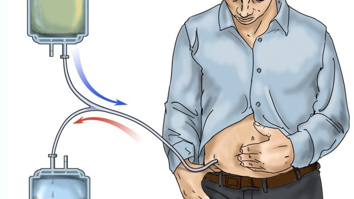 buona sanita nell asl napoli 3 sud attivata la dialisi peritoneale domiciliare