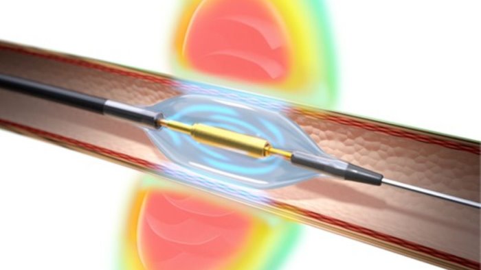 fatebenefratelli innovativo intervento per l ipertensione arteriosa