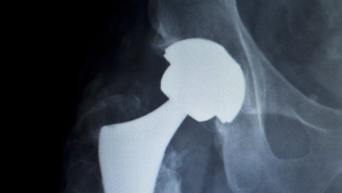 protesi d anca anteriore la mini invasiva spiegata dal dr caviglia