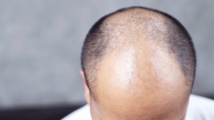 stop alla calvizie le patch cutanee di newlacecu