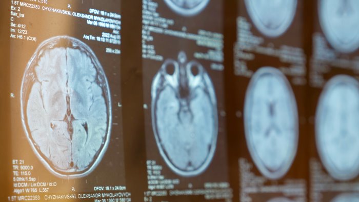 sclerosi multipla nuova scoperta cambia radicalmente visione