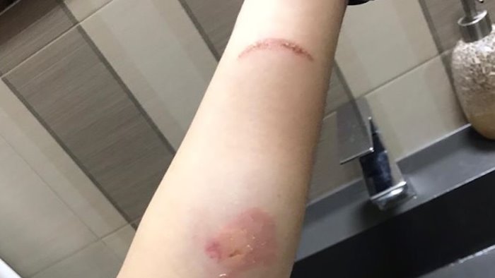 ruba ago a infermiera tenta di infilzarla poi la morde forte