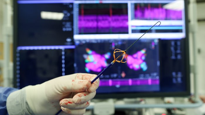 fibrillazione atriale eseguite due ablazioni a campo pulsato a benevento