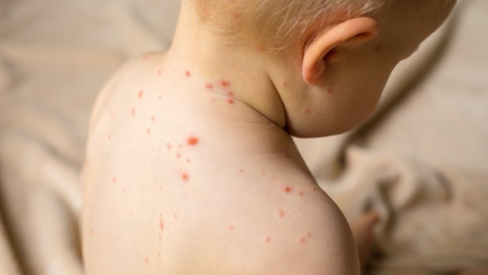 boom di casi di morbillo contagiati in particolare i non vaccinati
